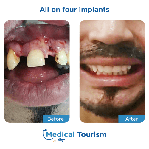 All on 4 before and after medical tourism international