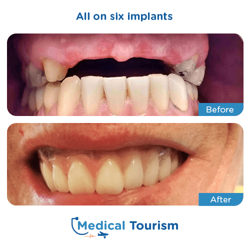 All on 6 before and after medical tourism international