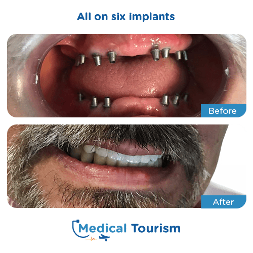 All on 6 before and after medical tourism international