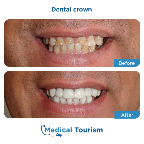 Dental crown before and after medical tourism international