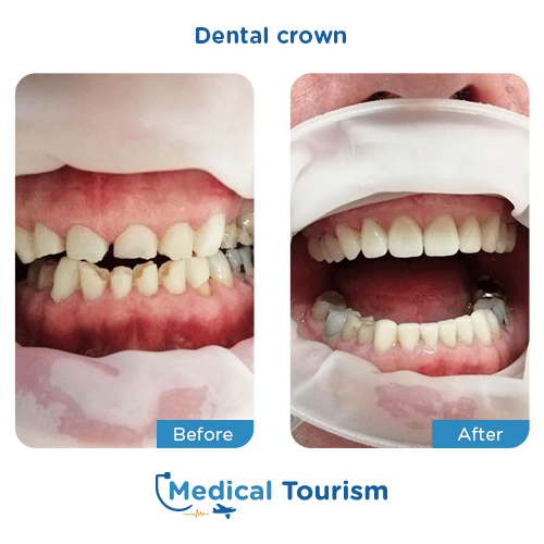Dental crown before and after medical tourism international