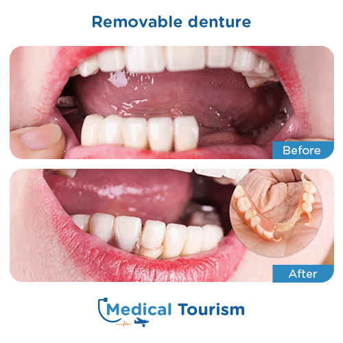 Removable denture before and after medical tourism international