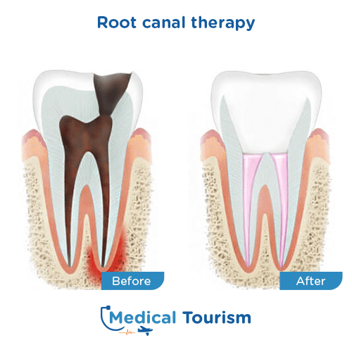 Root canal before and after medical tourism international