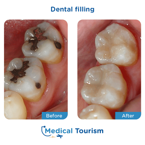Dental bridge before and after medical tourism international