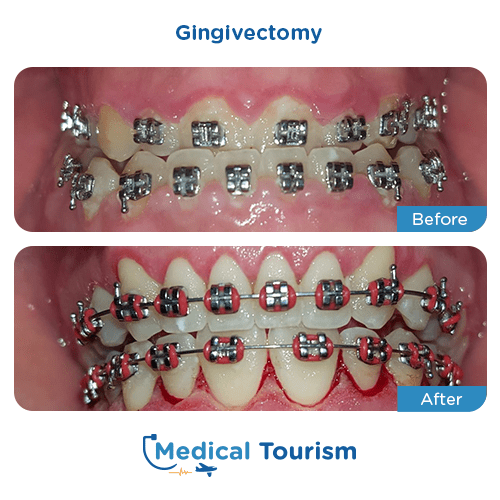 Dental bridge before and after medical tourism international