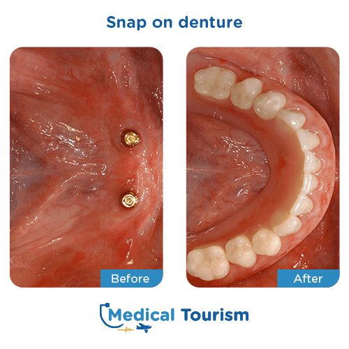 Snap on denture before and after medical tourism international