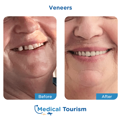 Dental veneers before and after medical tourism international