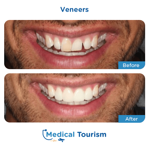 Dental veneers before and after medical tourism international