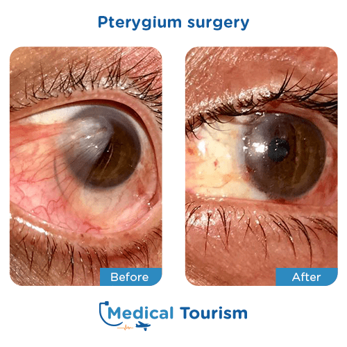 Aneurism before and after medical tourism international