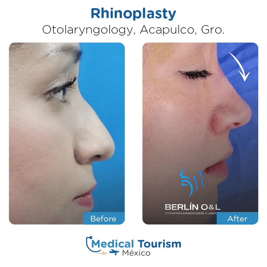 otolaryngology - ENT before and after of patients in Acapulco