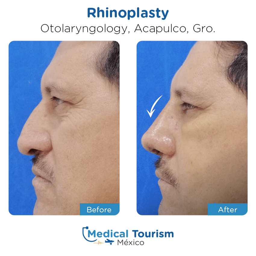 otolaryngology - ENT before and after of patients
                 in Acapulco
