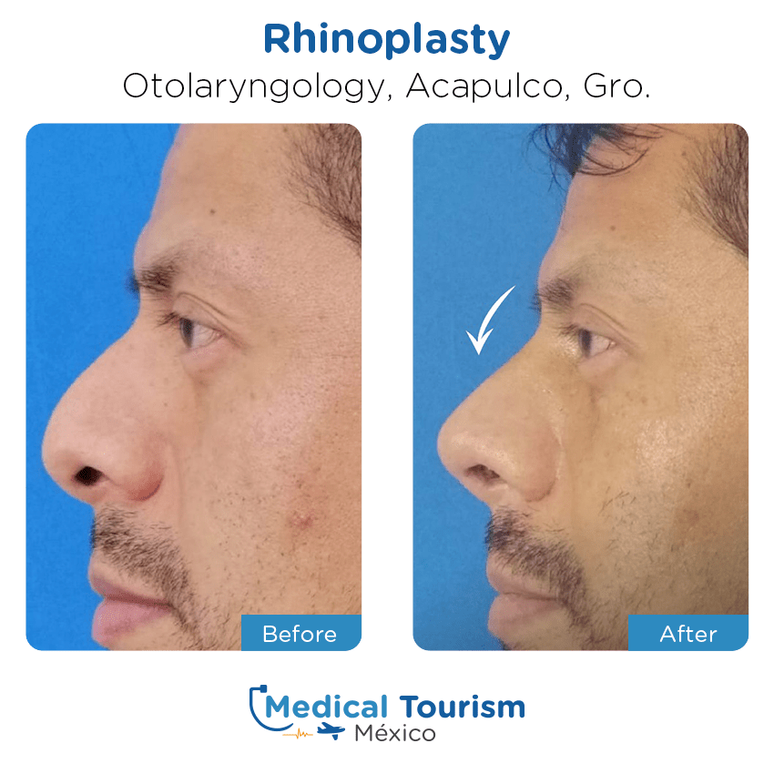 otolaryngology - ENT before and after of patients
                 in Acapulco