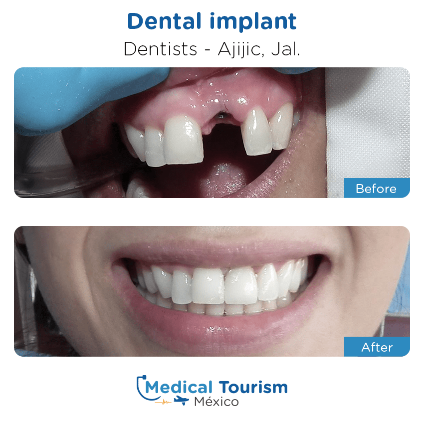 dental before and after of patients
                 in Ajijic