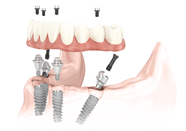 Illustrative image for all on four implants procedure