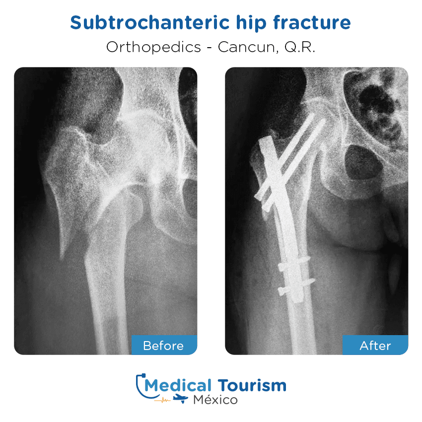 orthopedic before and after of patients in Cancún