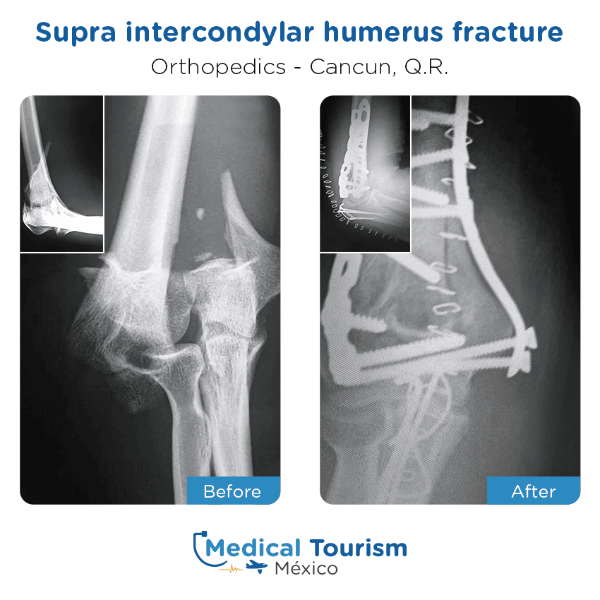 orthopedic before and after of patients in Cancún