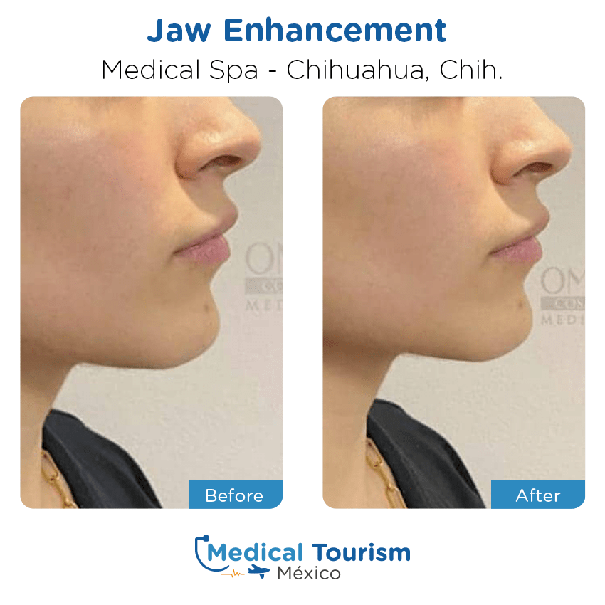 aesthetic medicine before and after of patients in Chihuahua