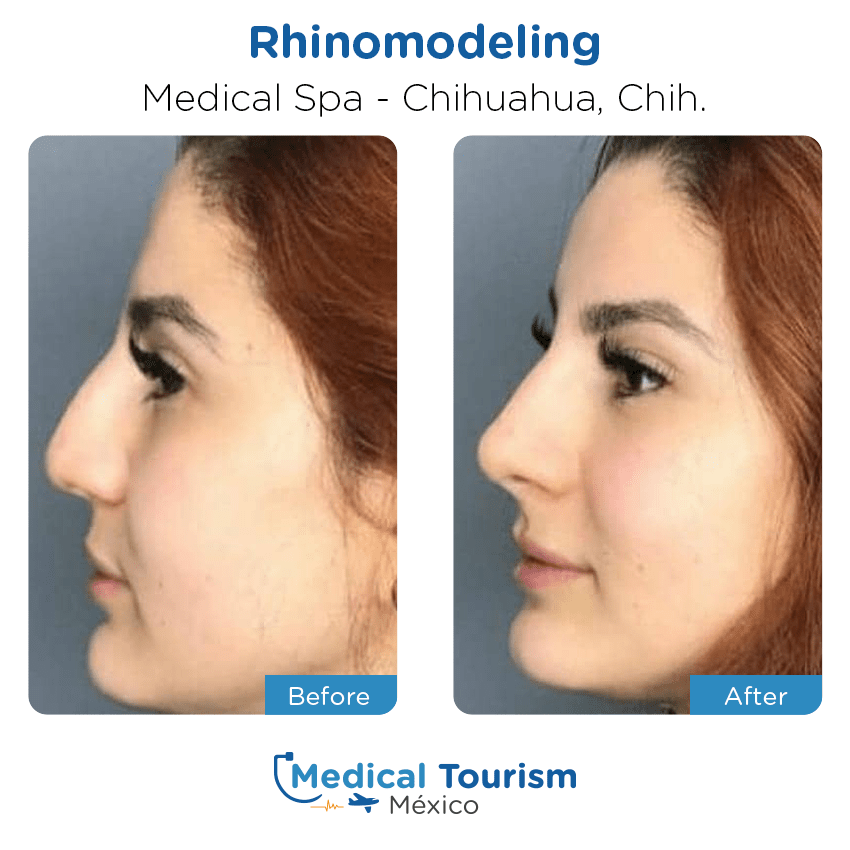 aesthetic medicine before and after of patients
                 in Chihuahua