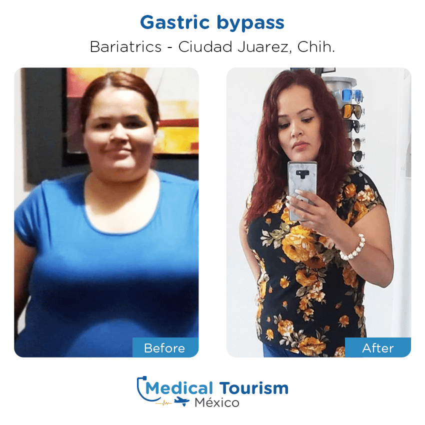 bariatric surgery before and after of patients
                 in Ciudad Juárez