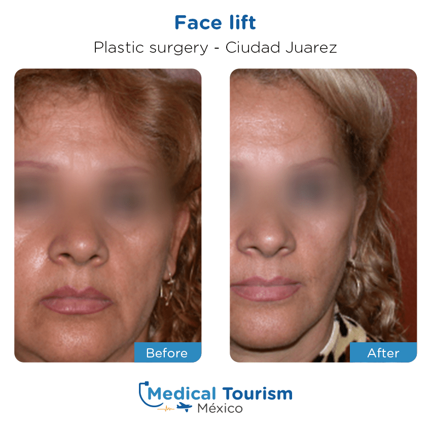 plastic surgery before and after of patients
                 in Ciudad Juárez