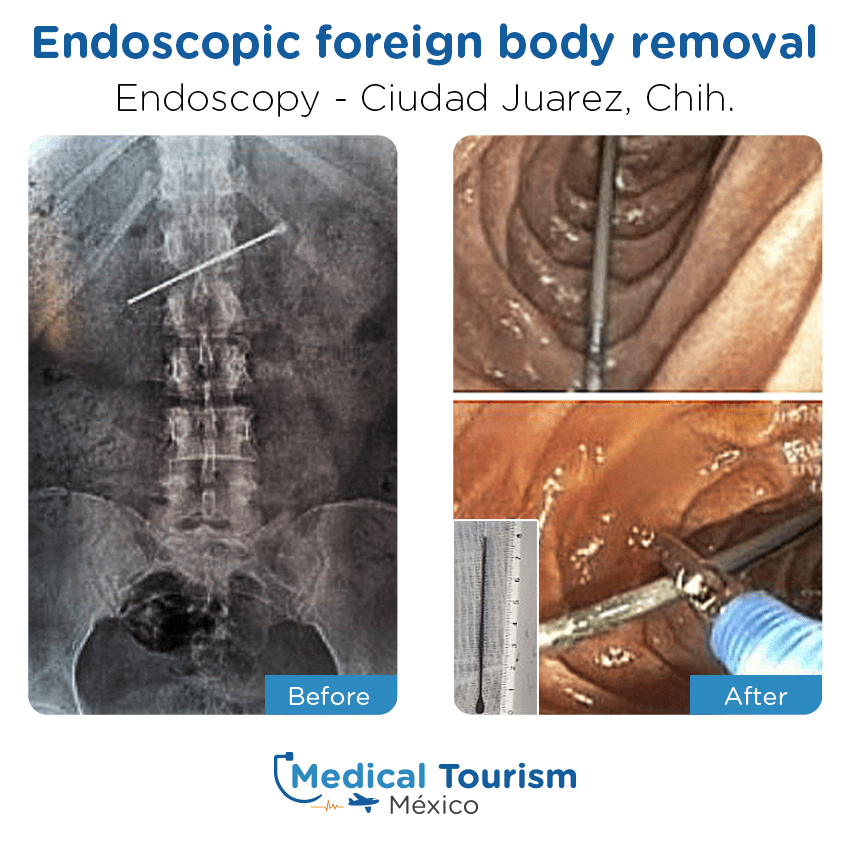 endoscopy before and after of patients
                 in Ciudad Juárez