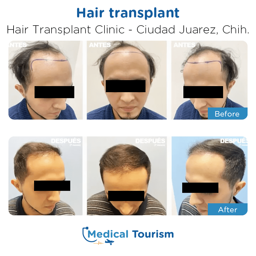 hair transplant clinic  before and after of patients in Ciudad Juárez