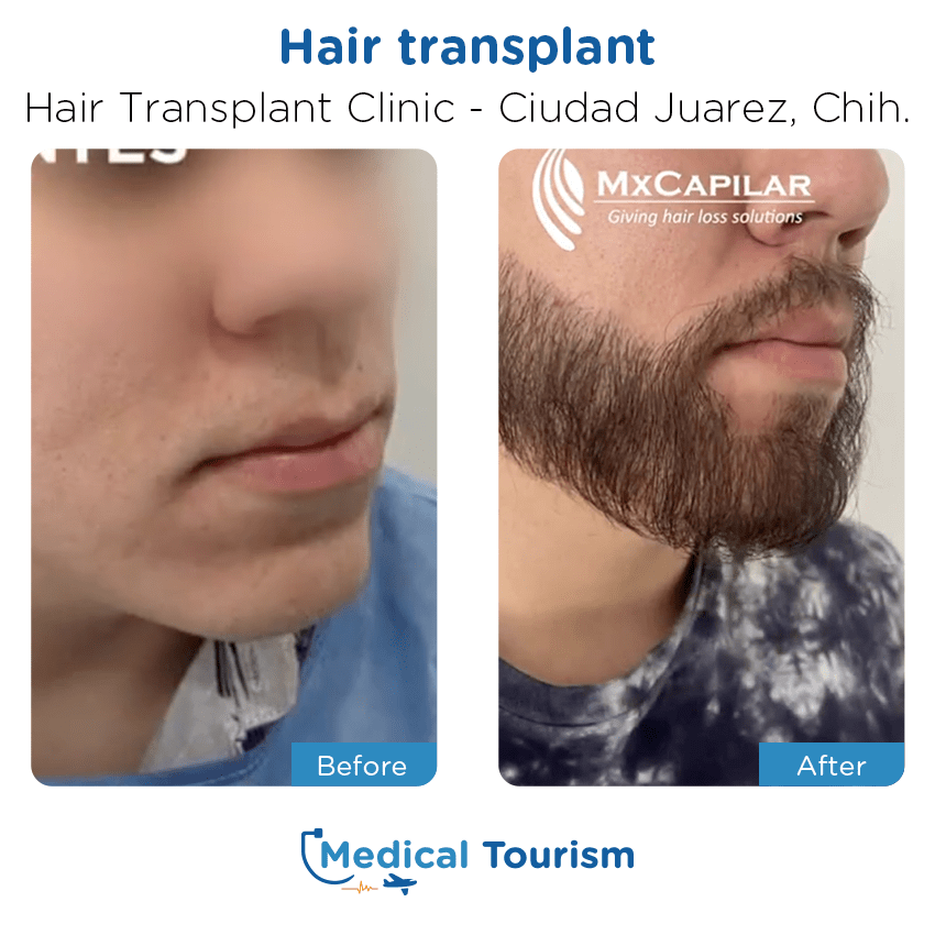 hair transplant clinic  before and after of patients in Ciudad Juárez