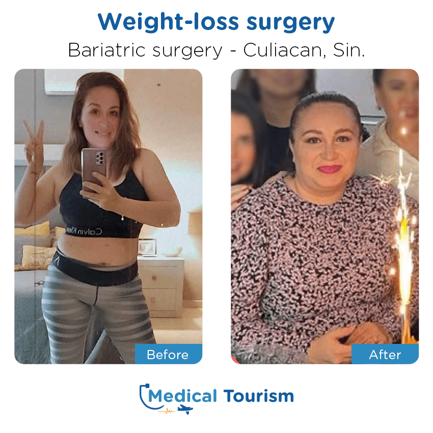 bariatric surgery before and after of patients in Culiacán