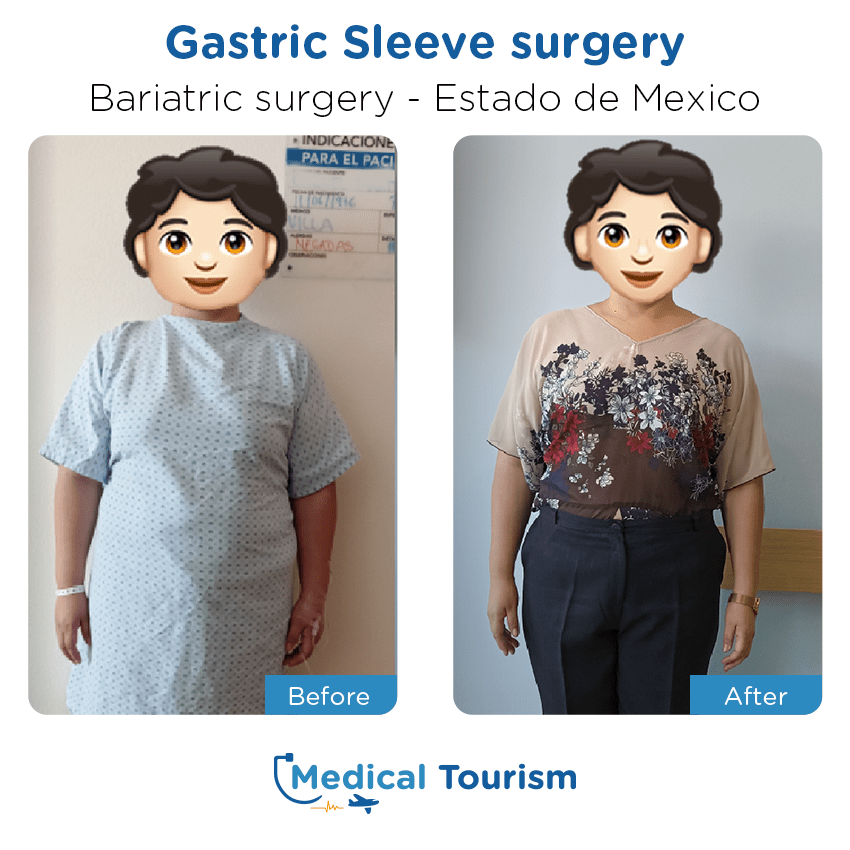 bariatric surgery before and after of patients in Estado de México