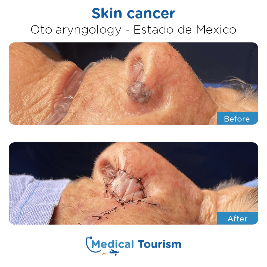 otolaryngology - ENT before and after of patients in Estado de México