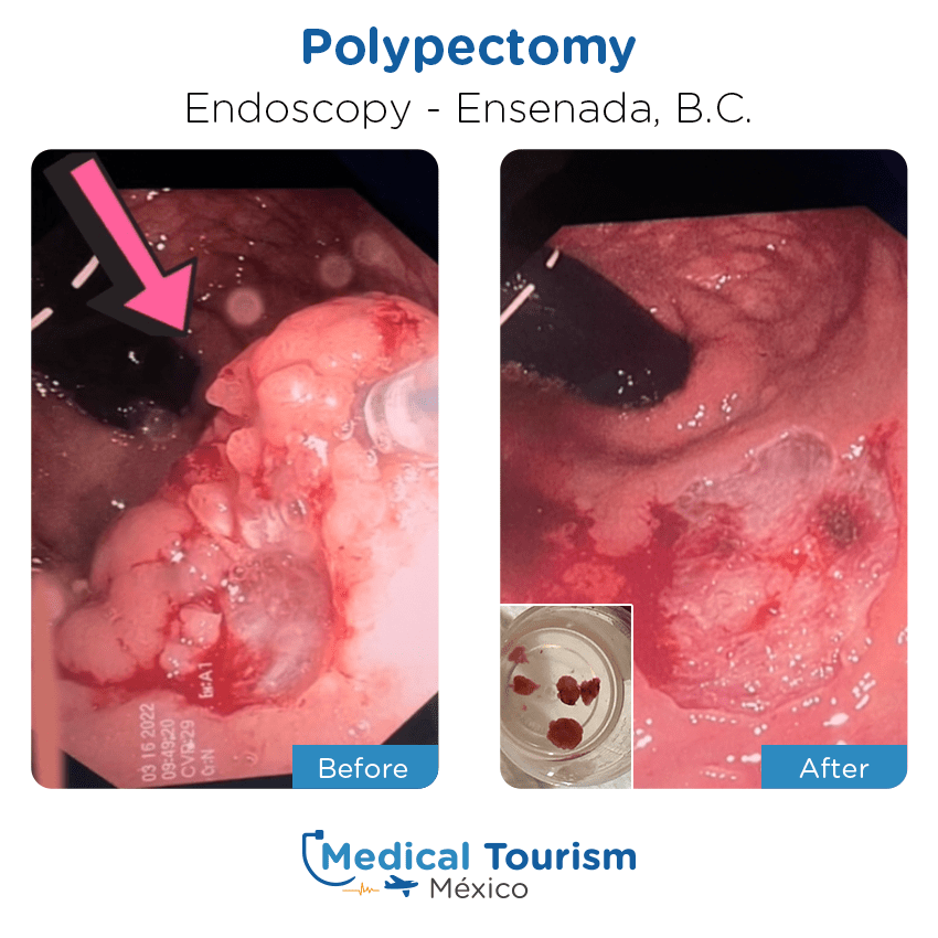 endoscopy before and after of patients
                 in Ensenada