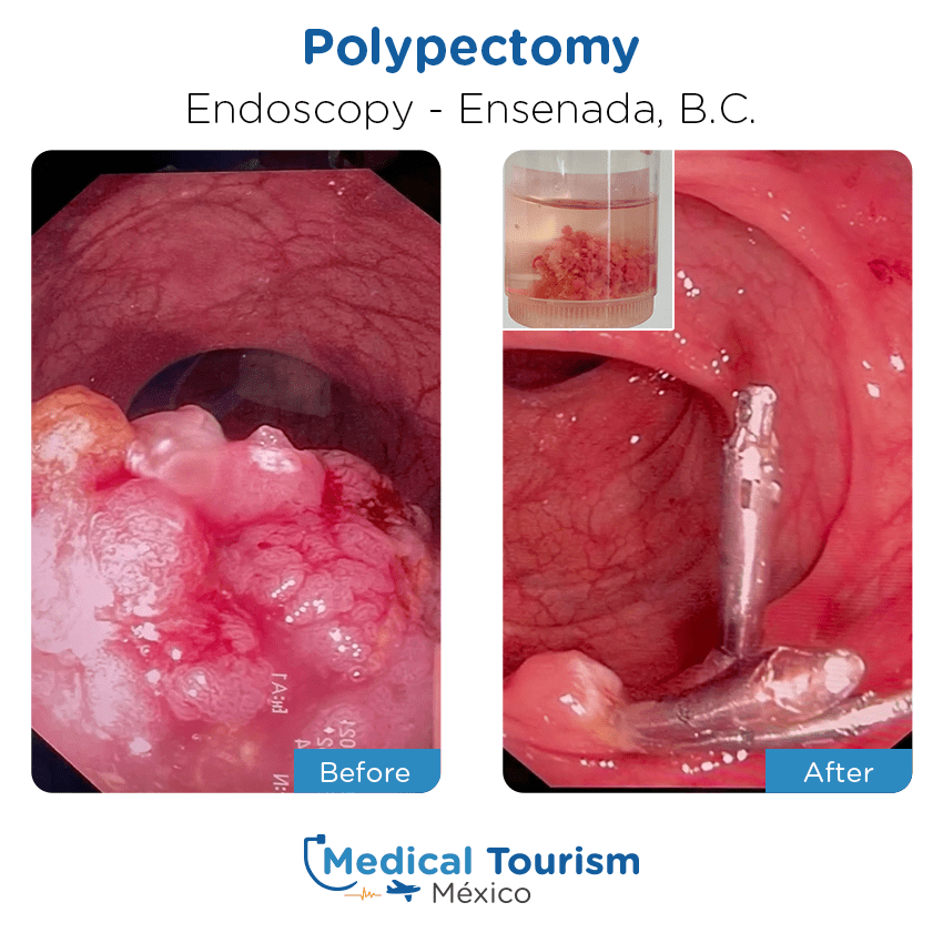 endoscopy before and after of patients
                 in Ensenada