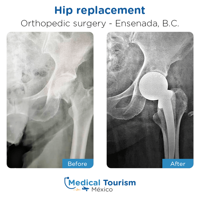 orthopedic before and after of patients
                 in Ensenada