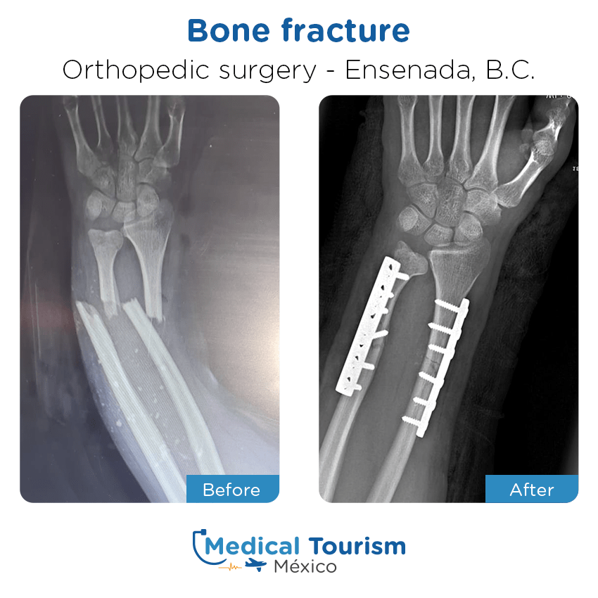 orthopedic before and after of patients in Ensenada