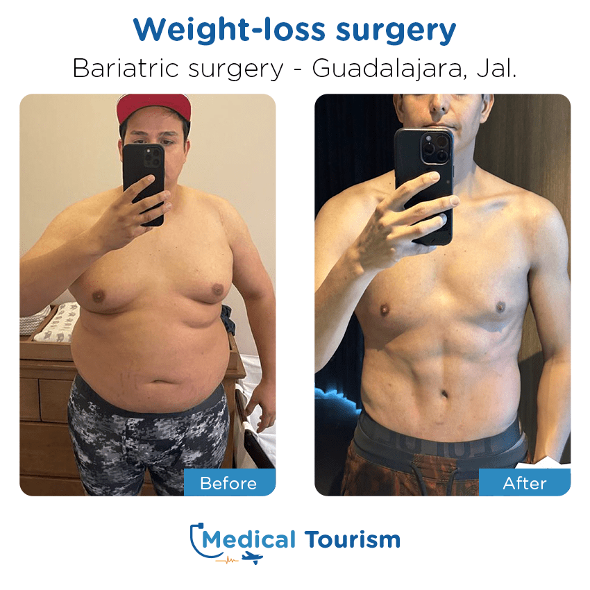 bariatric surgery before and after of patients in Guadalajara