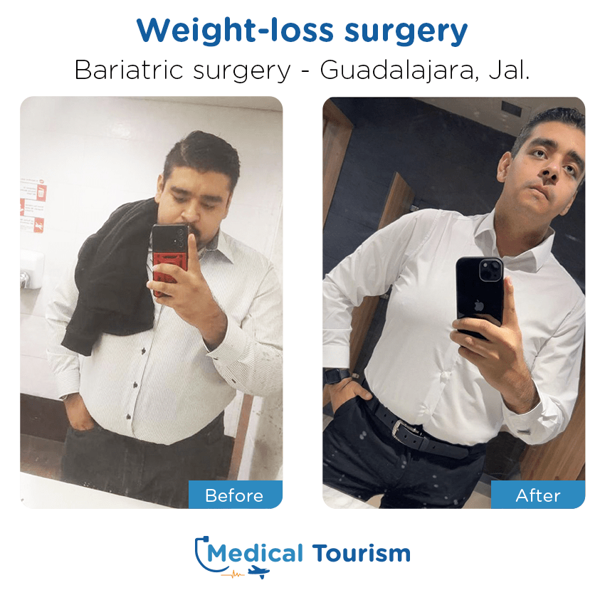 bariatric surgery before and after of patients in Guadalajara