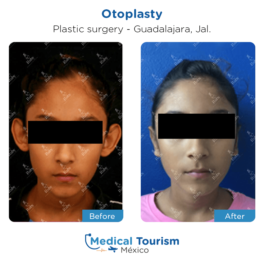 plastic surgery before and after of patients in Guadalajara