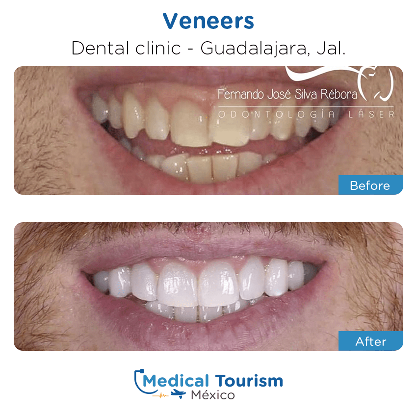 dental before and after of patients in Guadalajara