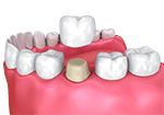 White dental crown