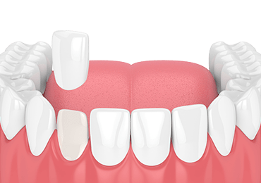 Illustrative image for dental veneers