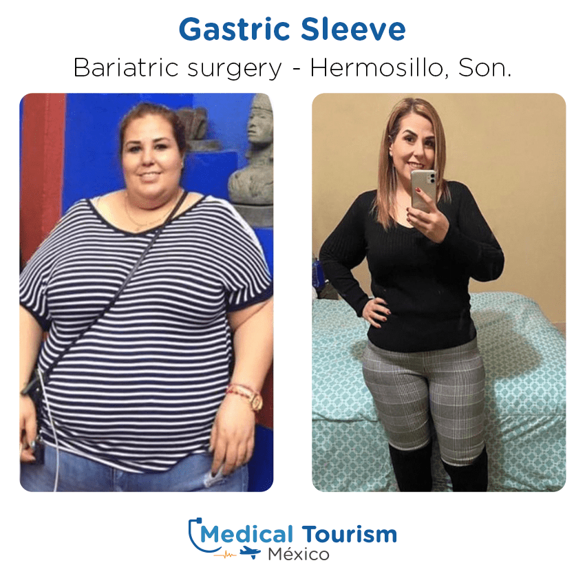 bariatric surgery before and after of patients in Hermosillo