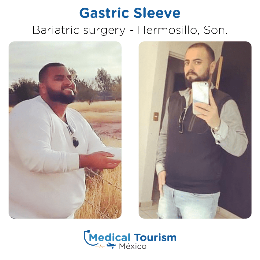 bariatric surgery before and after of patients
                 in Hermosillo