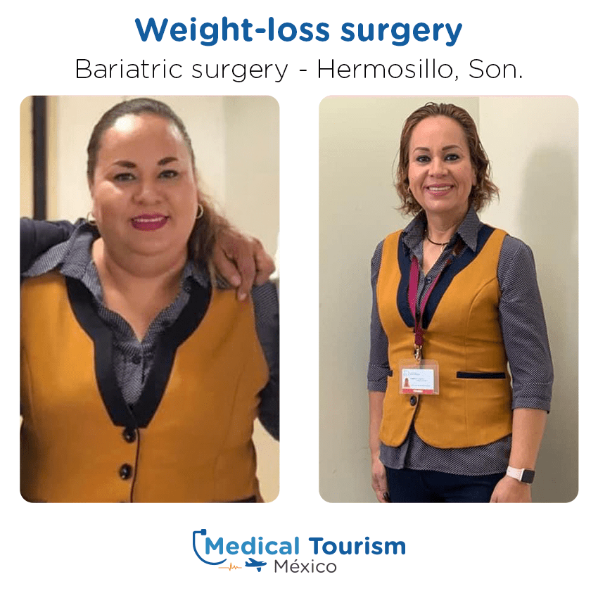 bariatric surgery before and after of patients
                 in Hermosillo