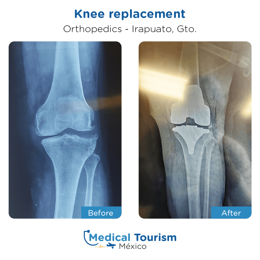 orthopedic before and after of patients in Irapuato