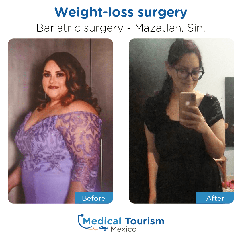 bariatric surgery before and after of patients
                 in Mazatlán
