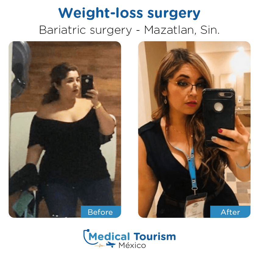 bariatric surgery before and after of patients
                 in Mazatlán