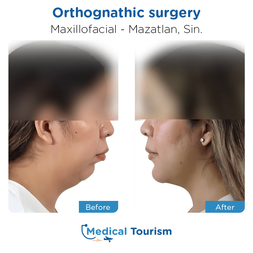 maxillofacial before and after of patients in Mazatlán