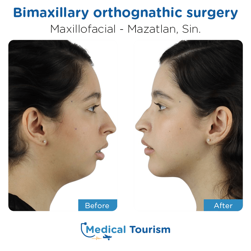 maxillofacial before and after of patients in Mazatlán
