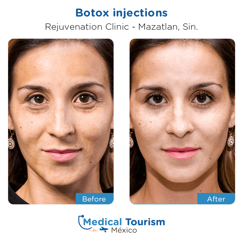 aesthetic medicine before and after of patients in Mazatlán
