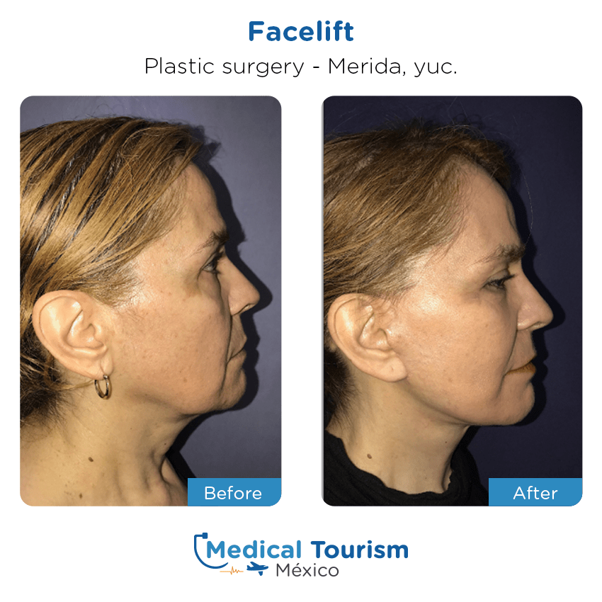 plastic surgery before and after of patients
                 in Mérida